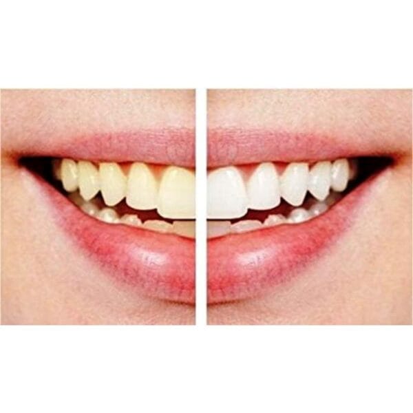 dazzling-white-teeth-whitening-pens